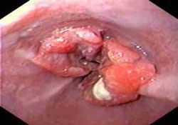 Hiccups, watch out for cancer
