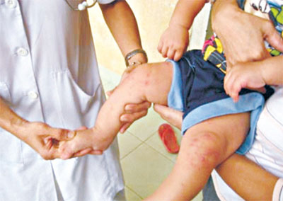 High alert for hand, foot and mouth disease