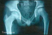 Hip pain in children
