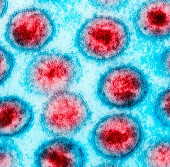 HIV-infected baby girl is cured