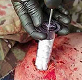 Hold blood for 15 seconds with a sponge syringe
