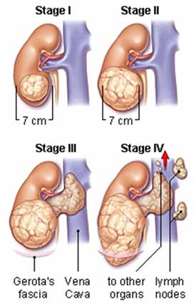 Hope for the treatment of kidney cancer
