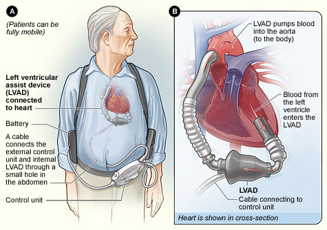 Hope to live for patients with severe heart failure