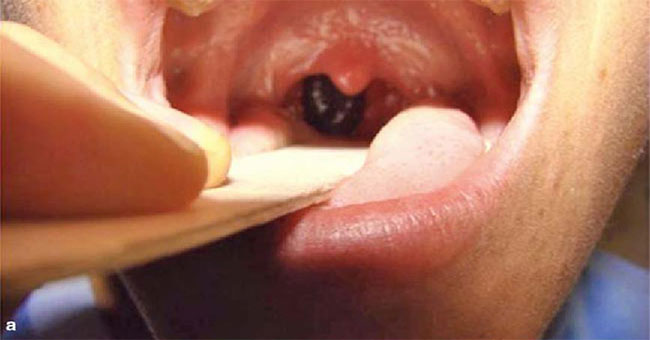 Horror story is true: what will happen if the parasite leeches in the throat?