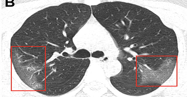 Hot: Publish photos of lungs devoured by corona virus
