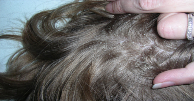 Hot sun raises the risk of scalp fungus