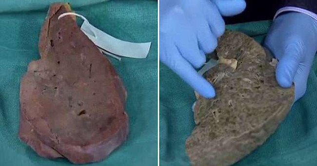 How does beer devastate your liver?