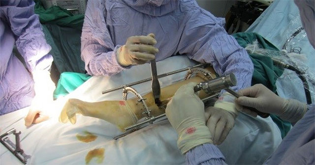 How does leg lengthening surgery work?