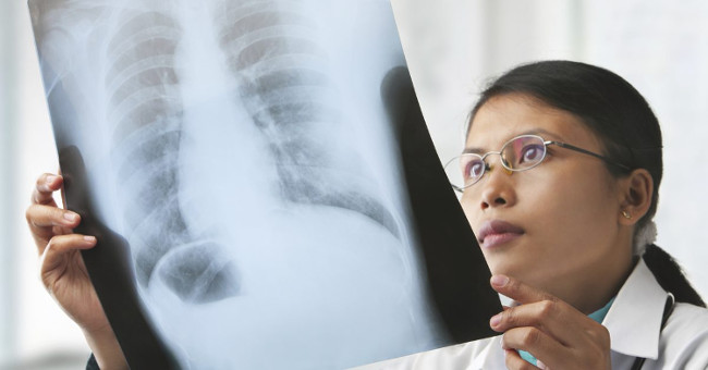 How is screening for early detection of lung cancer?