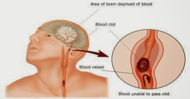 How not to die unjustly because of the wrong stroke with the wind?