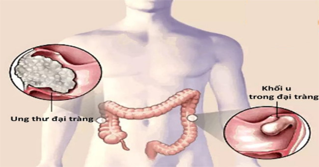 How often should colonoscopy check for colorectal cancer?