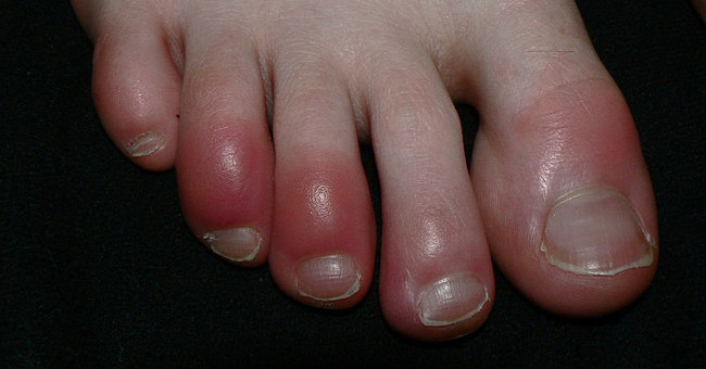 How to cure foot and mouth disease in the cold, cold and cold winter