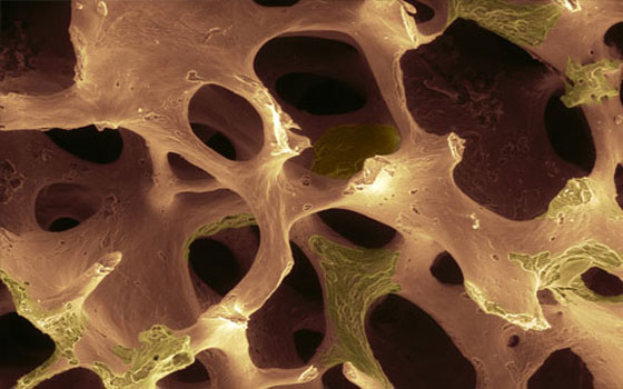 How to detect osteoporosis at the earliest stage