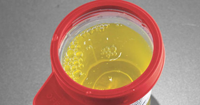 How to guess disease from urine color