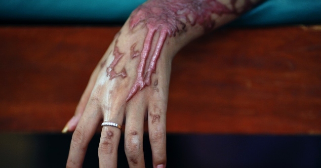 How to handle when the body is exposed to acid