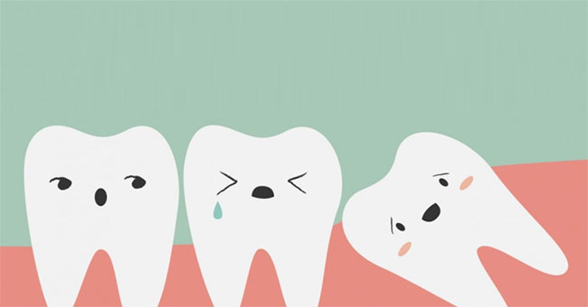 How to handle when wisdom teeth 'grow wild'?