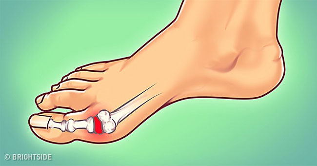 How to limit the terrible pain caused by gout