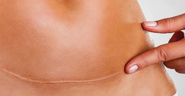 How to make the incision heal?