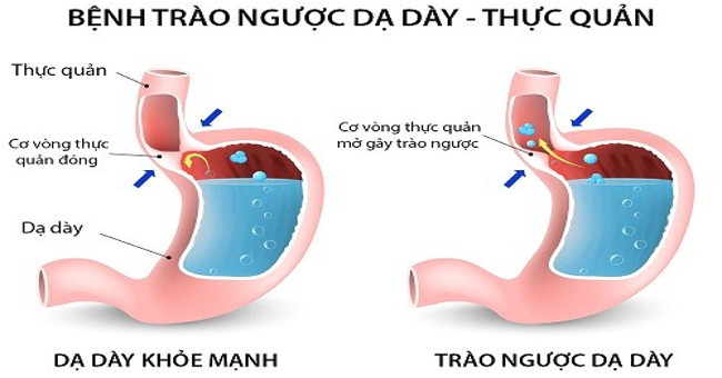 How to prevent stomach acid reflux