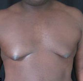 Hundreds of men have to remove their breasts