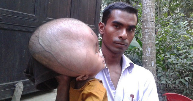 Hydrocephalus in children: Causes, identification signs and prevention