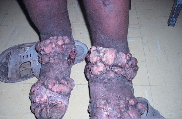 Identify genetic variation that increases elephantiasis