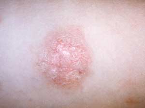 Impetigo in children increased sharply