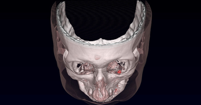 Implant magnets into eye sockets to cure disease