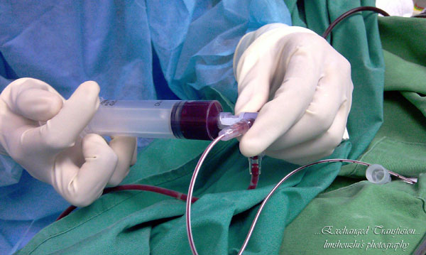'Improving old people,' brain with blood replacement