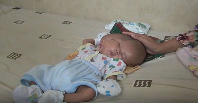 Indonesian boys have the most rare malformations: born with 2 faces and 2 brains