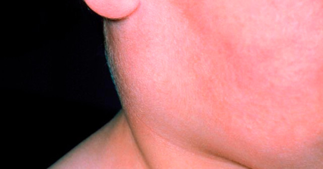 Infertility due to testicular atrophy because of mumps