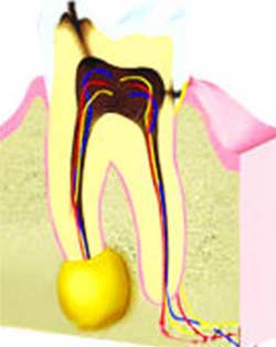 Inflammation around the tip of the tooth
