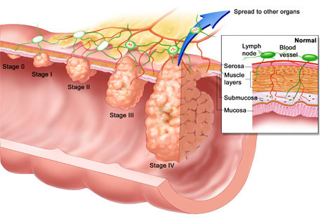 Inflammation contributes to colon cancer