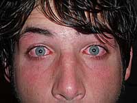 Initial management when eye burns