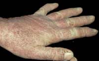 Insect contact dermatitis