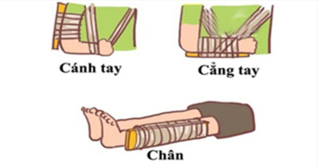 Instructions for first aid for children with broken bones