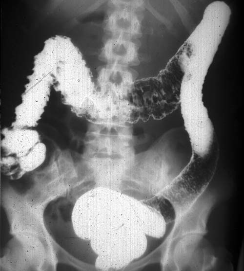 Intestinal diseases and risks in pregnant women