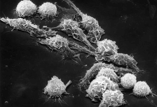 Is EBV virus the cause of cancer?