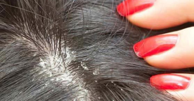Is it a piece of dry scalp?
