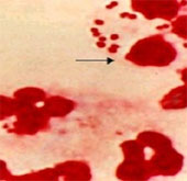 Is it true that gonorrhea spreads through ... washing machine?