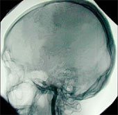 Is the body still alive after brain death?