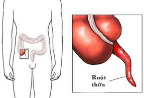 Is the intestine redundant?