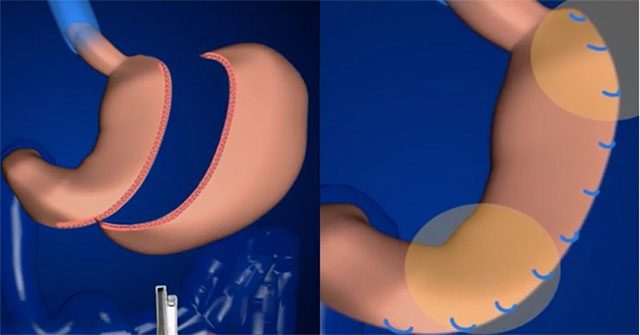 Is the stomach shrink surgery for weight loss really safe?