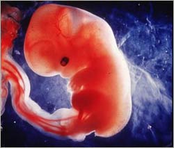 It is possible to detect Down syndrome without amniocentesis