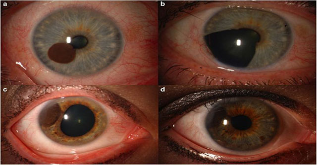 It turns out that the iris may also have cancer, and what happens afterwards will startle you