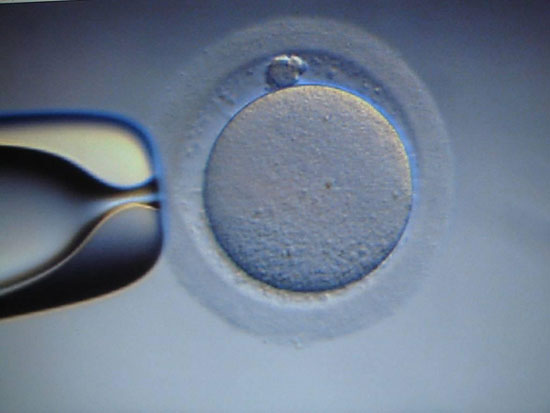 IVF is easy for ovarian cancer