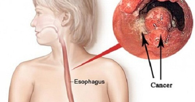 Japan announced a new method of treating esophageal cancer