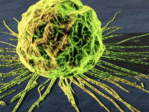 Japan discovered the gene that accelerates cancer metastasis