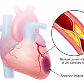 Kardiosens device warns early myocardial infarction