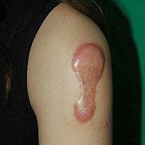 Keloids treatment
